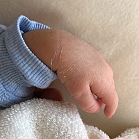 新生儿手腕弯曲是否正常？