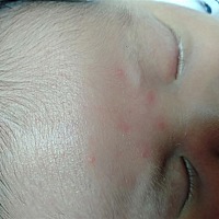 这是湿疹吗？？要用什么比较好用？？