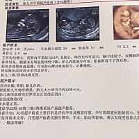 NT过了，能看出男宝还是女宝吗？