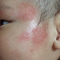 不像湿疹，火热火热的，有没有一样的宝宝，怎么处理的？