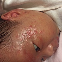 这是痱子还是湿疹？该怎么办？