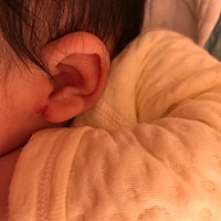 宝宝害耳底怎么办？