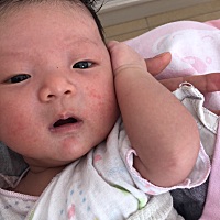 湿疹真是让我头疼