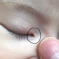 宝贝内眼角有一个白点儿，我以为是眼屎，结果半天擦不掉。像个小白头似的，有宝妈知道这是啥情况嘛？