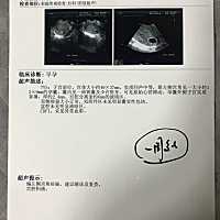 偏左侧宫角 医生说偏左侧宫角一周后还是这样，要我流了，怎么办。还有机会回正吗？