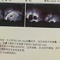 生双胎的宝妈们看过来，能帮我看看这是双胎吗