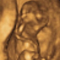 11周的nt 有会看的宝妈吗