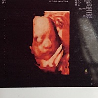 宝宝一周了，之前发育小三周，担惊受怕，6.5斤，刚刚好，40周刨腹产，女孩哦，看看和四维像不像