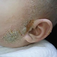 直到今天才回来写用药的效果，是因为我想看看到底停药之后会不会有复发。我儿子是2017年10月份，医院确...
