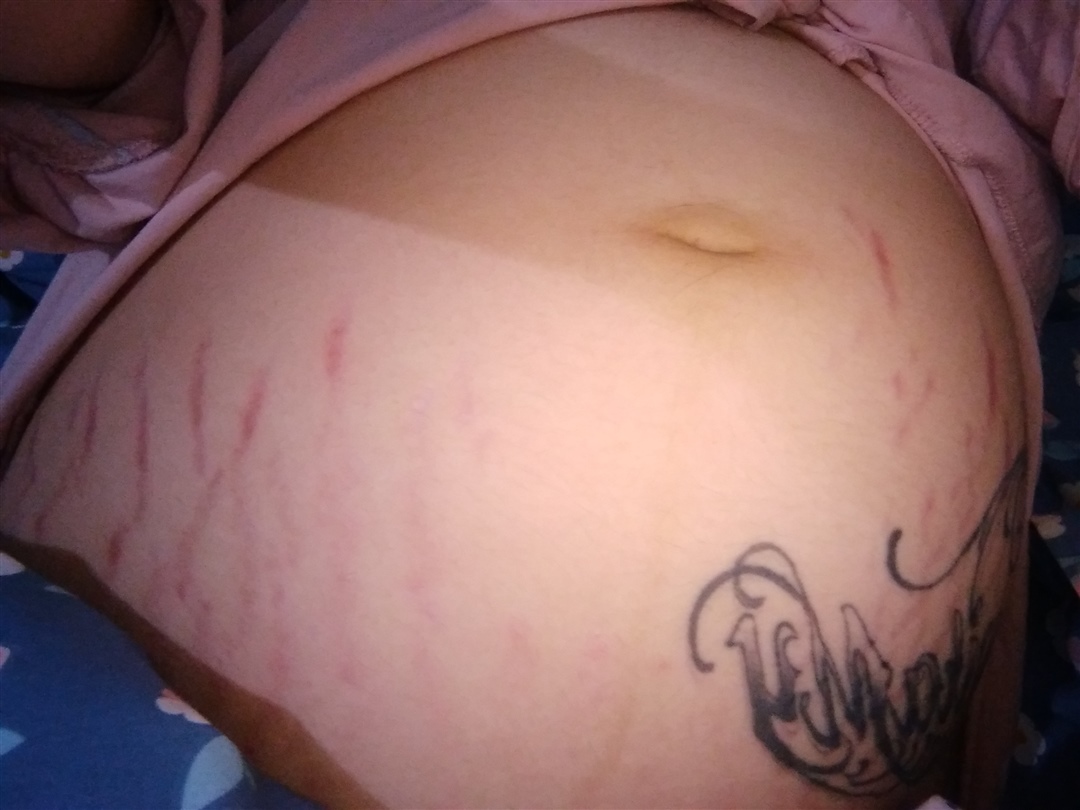 怎么办，橄榄油也擦了