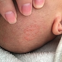 有宝妈知道这是什么吗。涂了婴宝好了 然后又会在同位置长出来，好了就会起皮。