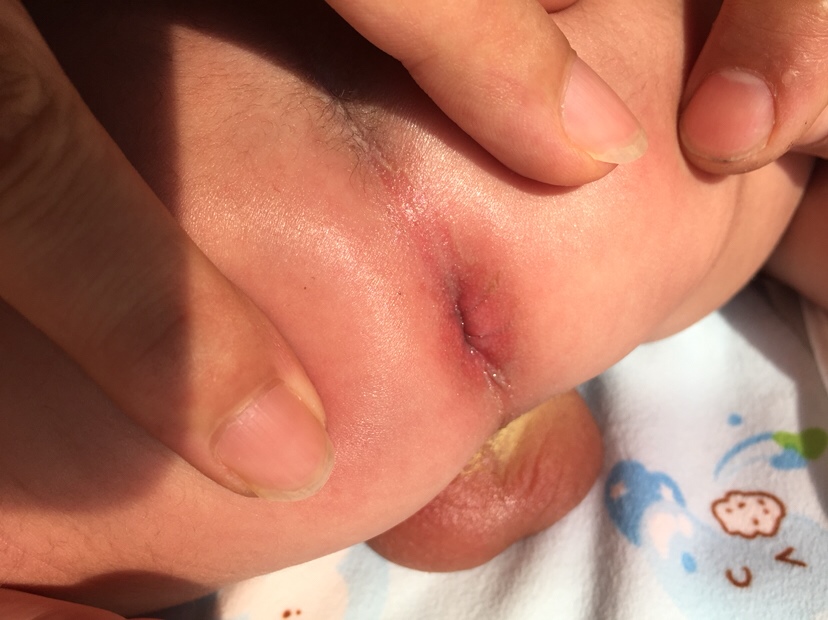 这个腚上淹了怎么办 宝妈们