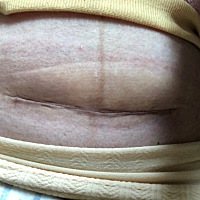 刨腹产还是没有顺产好