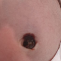 宝妈们，请教一下，急！急！宝宝的肚脐脱落后，有结痂，这结痂什么时候脱落？流血了要不要看医生啊？