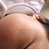 想问下各位宝妈么，这个脸上的是什么疹子，要怎么处理？