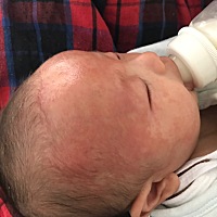 真的没有捂着，但是宝宝全脸都是疹子，变得通红，身体几乎没有，看着很像过敏😭😭😭