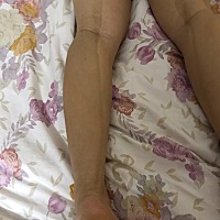 为什么腿上会长妊娠线？从臀部一直到脚后跟上，两条腿都一样，为什么会这样呀？会不会消呀…… 好难看。...