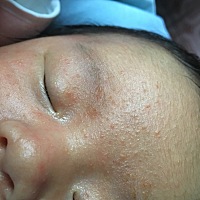 请问这是湿疹吗？睡着了不明显，一用力就出来了，麻烦各位帮忙推荐一下好用的湿疹膏🙏🙏