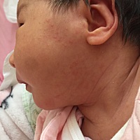 谁知道这是什么，湿疹还是痱子？小红点上面有白头. 一哭就明显，时多时少！涂什么有用呢！