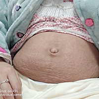 生完宝宝后，肚子的妊娠纹还是痒痒的，之前买的橄榄油擦了也不好，怎么办啊？？ 产后15天