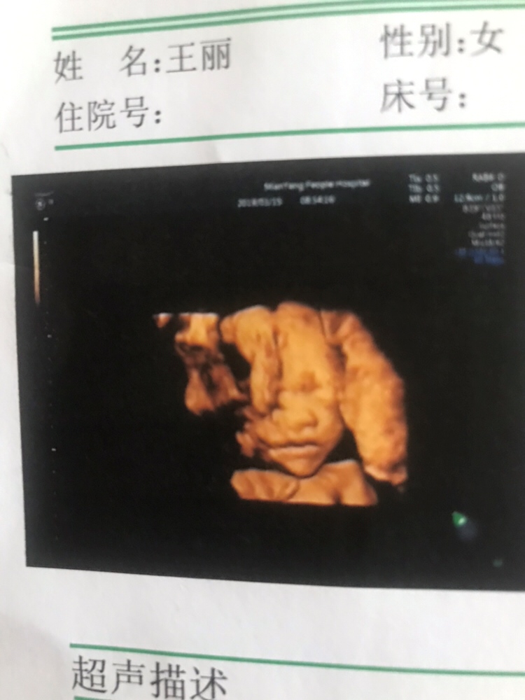 前天做了四维，我的猪北鼻还是个尖下巴，看着是个女孩子哦，还挺可爱的