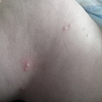 有没有宝宝长这种痘痘的，买了药不见好