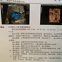 怎么拍到小猪嘴是嘟起来的呢？有谁看得出是男宝还是女宝吖？头胎，就是比较好奇