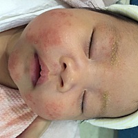 宝妈们，宝宝脸上是湿疹么，擦什么药管用啊，看着特心疼