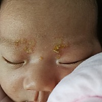 有宝妈知道我女儿眉毛那里长的是什么吗？应该要怎么处理？涂点什么？谢谢大家了。