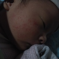 宝宝今天21天了，脸上一直出现这种小痘痘，各位宝妈怎么缓解呀