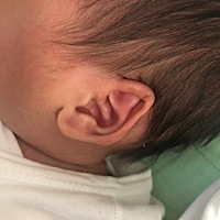 宝宝耳朵从出生时就这个样子，左耳外侧耳骨折进去一块，以后能不能长好？需不需要去矫正啊？有没有宝宝...