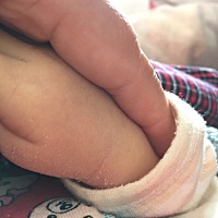 宝宝出生一个礼拜，今天在家给他洗好澡之后发现几处皮肤像图片一样脱皮，这个是正常现象吗？ 有知道的宝...