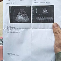 17 1医生说宝宝头大，，你们宝宝17 1双颈经多大呢？