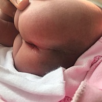宝宝屁股眼周围红红的，屁股沟还裂了。可能是没有清理好，淹了。现在因为这个问题婆婆也很着急，因为到...