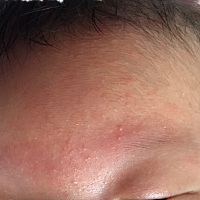 请问宝妈们这个是湿疹吗？请问有什么办法消下去，宝宝脸上长很多，求解，拜托。