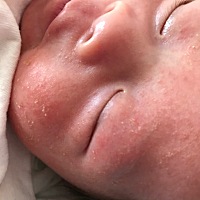 之前一下子爆发涨了满脸，这好不容易消下去结痂起皮了，今早一起来一看，额头发际线边有的又冒了很多出...