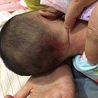 剪了满月头才看到这么一大块跟胎记似的，有宝妈知道这是什么吗？