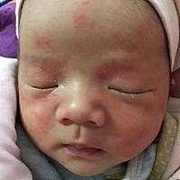 请问这是湿疹吗？有什么办法可以消下去？