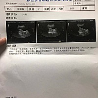 怀孕52天了无胎芽胎心，是不是发育不好？会不会停胎？