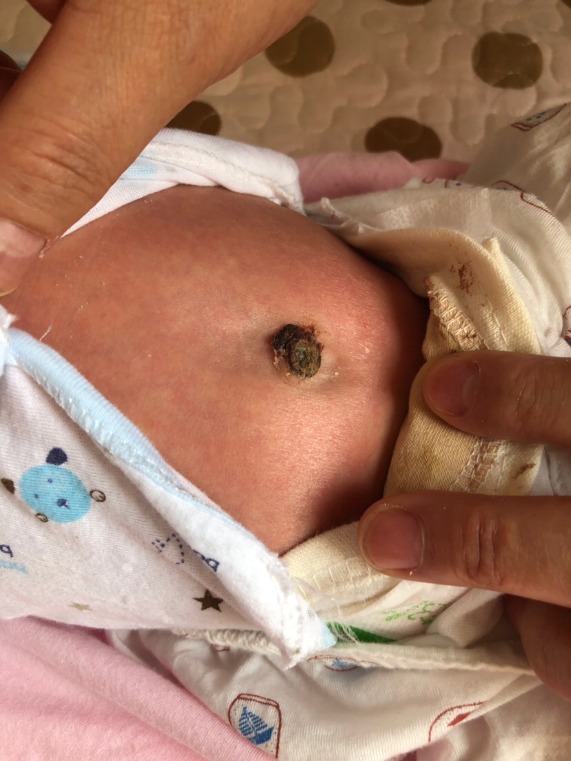 你们都是怎么护理肚脐的啊！我们15天了还没掉呢！