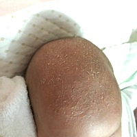 宝宝头皮湿疹怎么办？用了贝亲润肤油按摩清洗，隔天又会长出来。