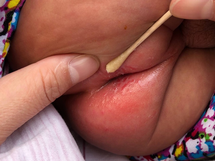 如果有情况跟我们一样的话，可以用这个办法，我去医院看了，宝宝两天就好了，希望能帮到大家第一步康复新液，每天用纱布浸湿敷患处。一天敷几次，第二步喷莱沃芙宁这个喷剂，第三步炉甘石洗剂加制霉素片，制霉素片去糖衣，磨成粉末，跟炉甘石洗剂搅在一起，每天涂患处几次，自己去药店买我在医院开的药挺贵的，如果药店买不到莱沃芙宁，就可以不喷这个，我家宝宝两天就好了，他如果拉稀挤黄水的话，给他吃思密达，也叫蒙脱石散，喝两三天，每次三分之一，祝大家宝宝也早日康复