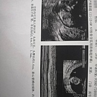 今天12周零2天，刚拍了NT，大家帮忙看看是男孩女孩