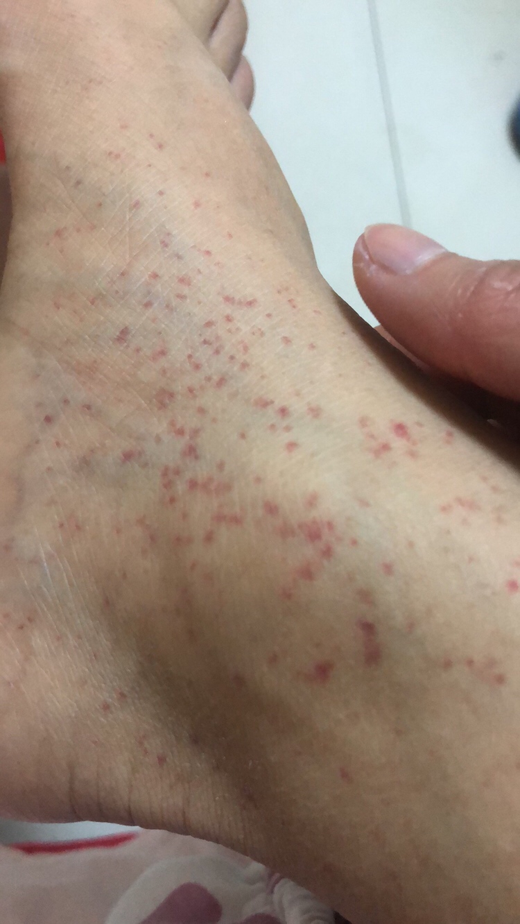 怀孕10周，突然发现脚上长了好多红点，不疼不痒，有哪位同胞知道这是怎么回事