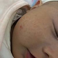 请教各位，我幺儿脸上长了湿疹，我给她抹了婴亲霜，然后脸就一直这样了……请问有什么办法能把这个去掉...