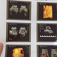 哪位懂的宝妈帮我看下。羊水少让我过一个礼拜去复查，让我这周多喝水。有必要去去复查吗？羊水少胎儿脸...