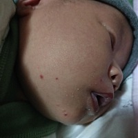 婴儿长这种红点越来越红是怎么了，有没有经历过的宝妈