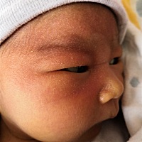 小宝十来天，昨天脸上红，今早起来脸上眼皮上都有这个，不知道什么情况，有孕妈知道不，求解答