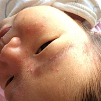 各位宝妈，宝宝脸上起的这个是什么东西啊，有没有宝妈知道的。🙏🙏