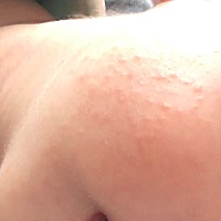 想问下宝妈，我家孩子一个多月，纯奶粉喂养，现在脸上开始出现越来越多的红点，是湿疹吗？我们也没有穿...